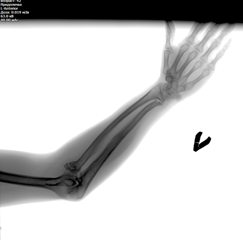 Не нашел: Здесь много разных людей, может есть травматологи, ортопеды! вот последние рентгены руки, мне стоит беспокоиться ?